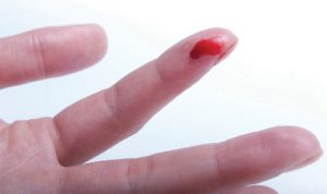 Cách cầm máu khi bị đứt tay