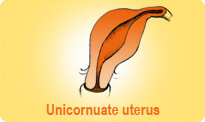 Unicornuate Uterus